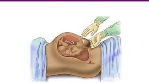 	توصيه هاي خودمراقبتي در سزارين